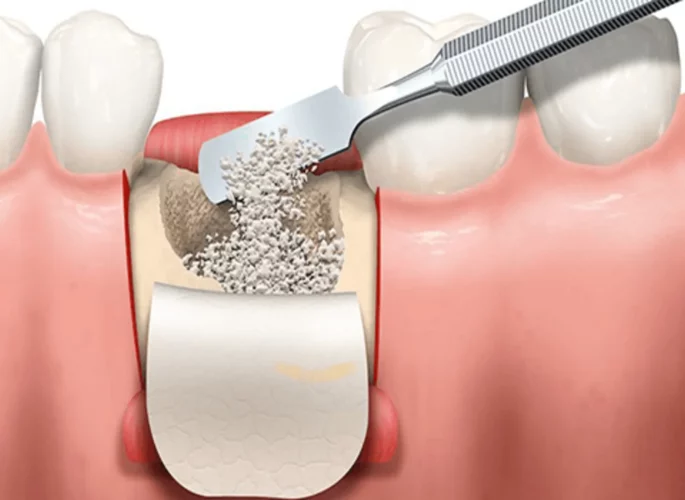 Bone-grafting-in-orthodontics