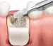 Bone-grafting-in-orthodontics